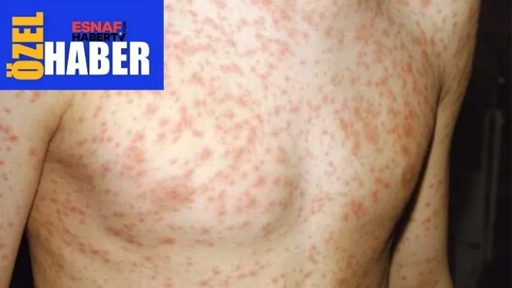 Kızamık S.O.S Verdi